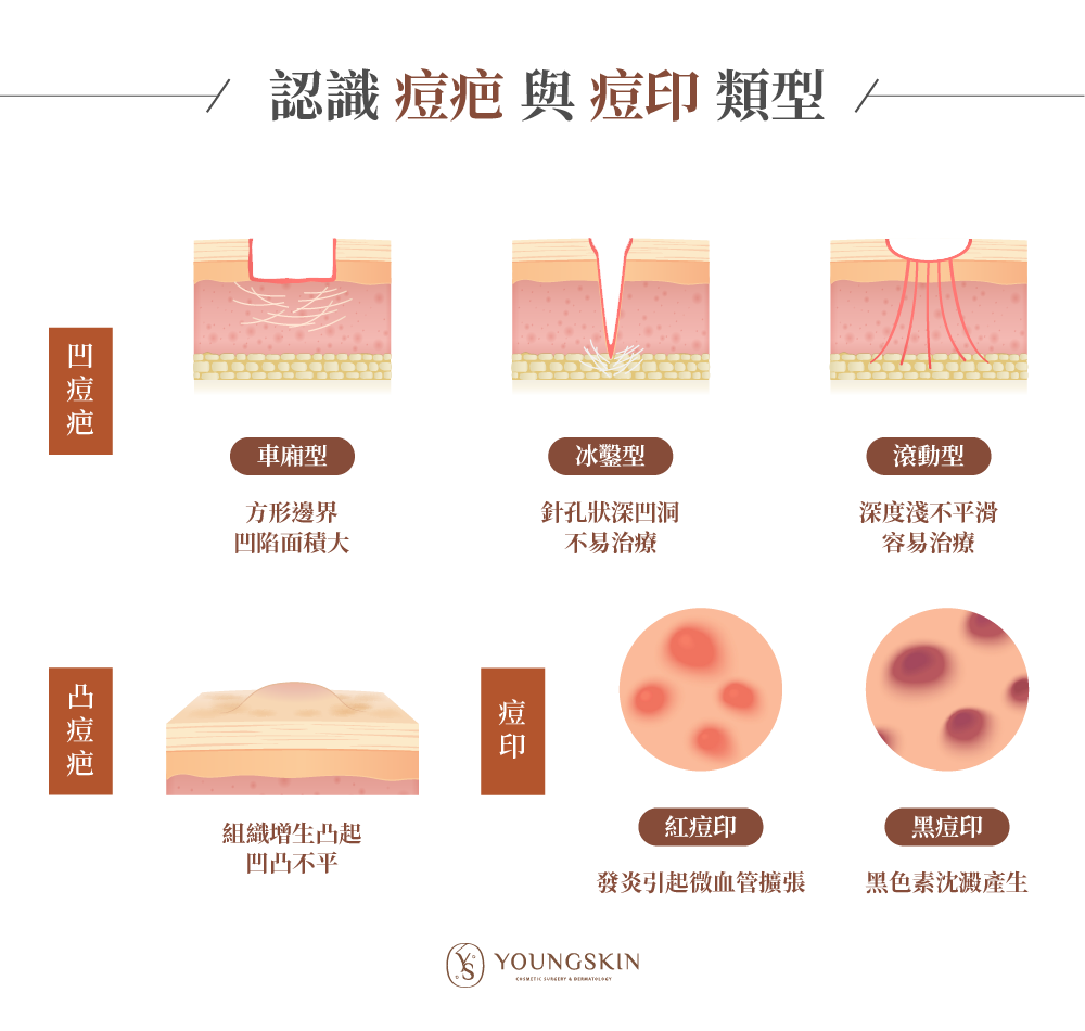 痘疤與痘印