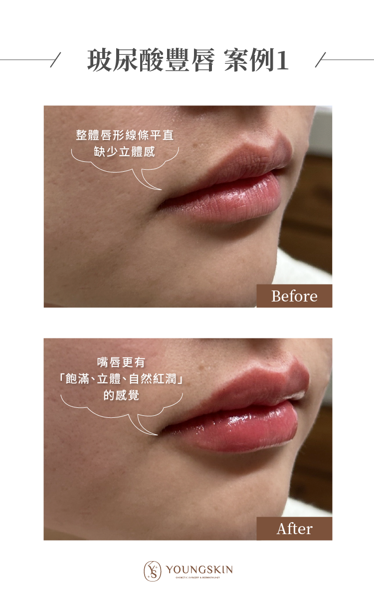 芯漾皮膚科診所 楊心怡醫師 玻尿酸豐唇案例1