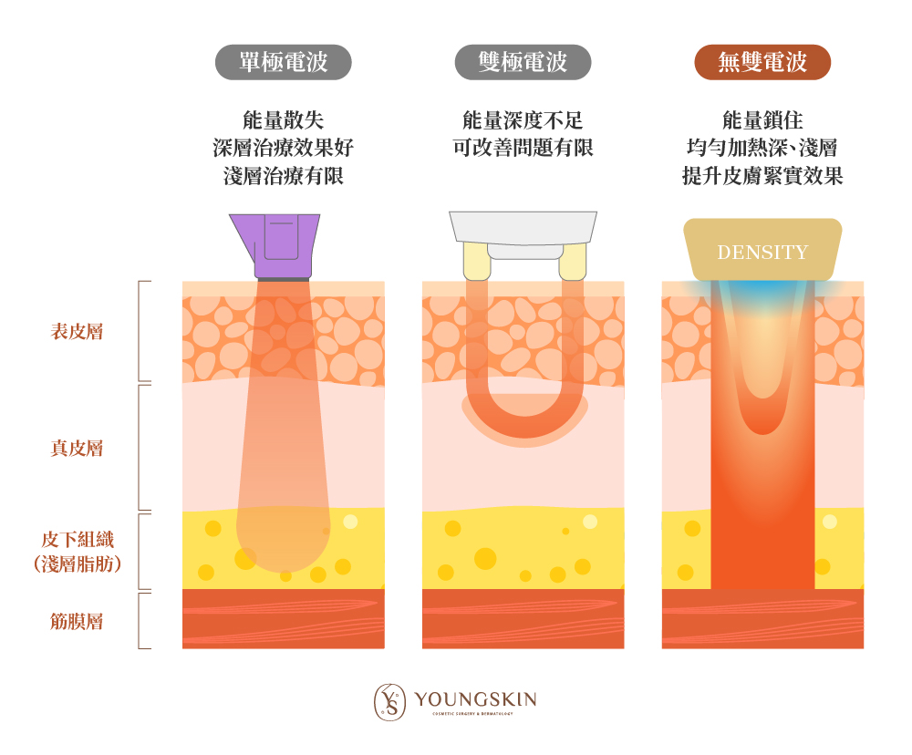 傳統單極電波、傳統雙極電波與無雙電波治療深度比較