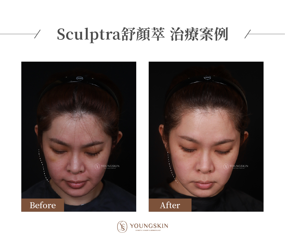 芯漾皮膚科治療案例，治療前患者因為老化流失，讓整體看起來下垂鬆弛、輪廓線模糊，經過Sculptra舒妍萃治療後，臉部外輪廓整體拉提，讓原本下垂的蘋果肌回到年輕時的位置，效果十分自然。