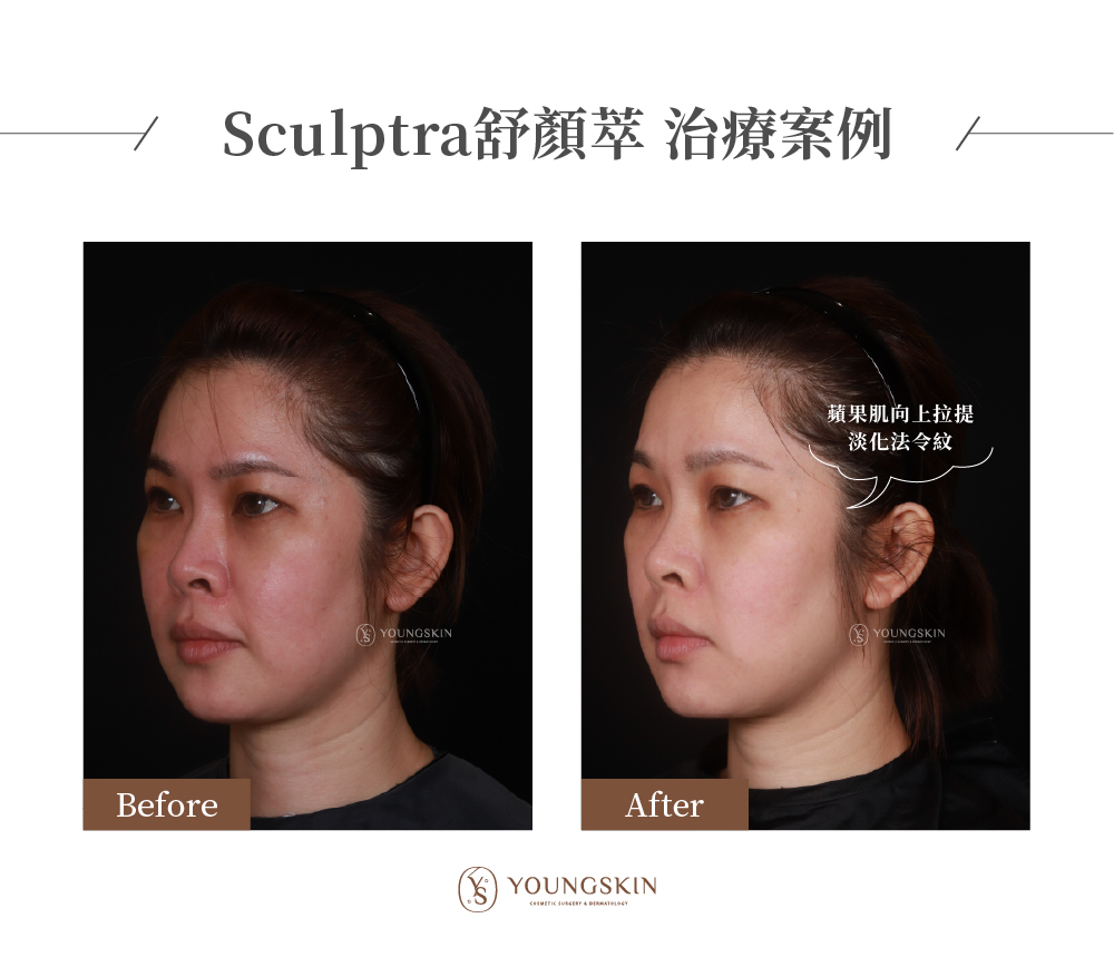 芯漾皮膚科治療案例，治療前患者因為老化流失，讓整體看起來下垂鬆弛、輪廓線模糊，經過Sculptra舒妍萃治療後，臉部外輪廓整體拉提，讓原本下垂的蘋果肌回到年輕時的位置，效果十分自然。