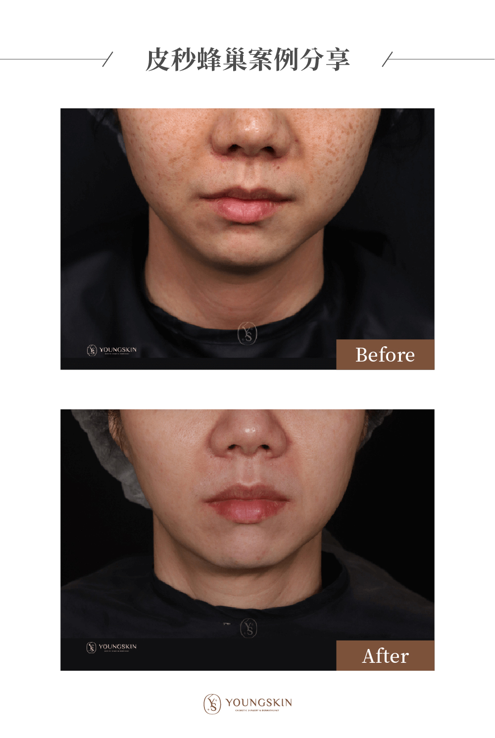 芯漾皮膚皮秒雷射效果，經過治療後斑點消失了80% 