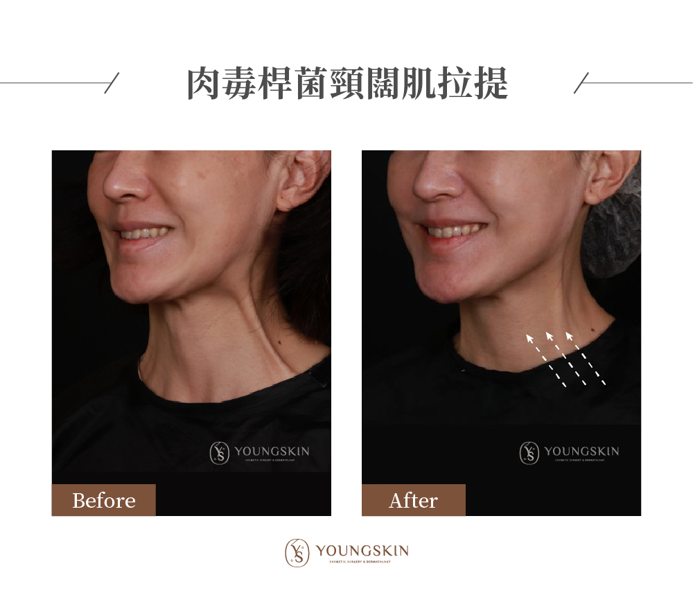 芯漾診所 肉毒治療案例 明顯改善「闊頸肌」，讓輪廓線變得簡單俐落