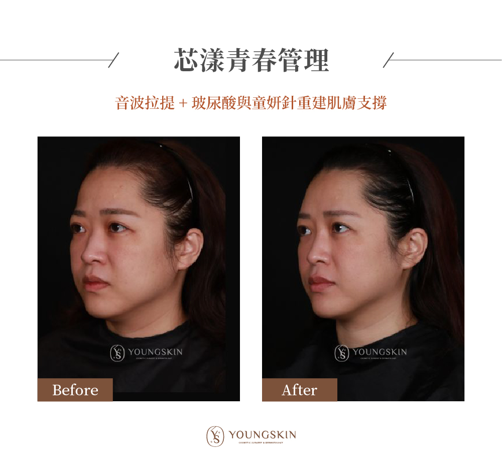 芯漾診所案例，楊心怡院長使用玻尿酸、童妍針並搭配音波複合式治療，讓五官變的立體集中，原本看起來疲累的眼神與下垂的嘴角，也都變得神采奕奕。 