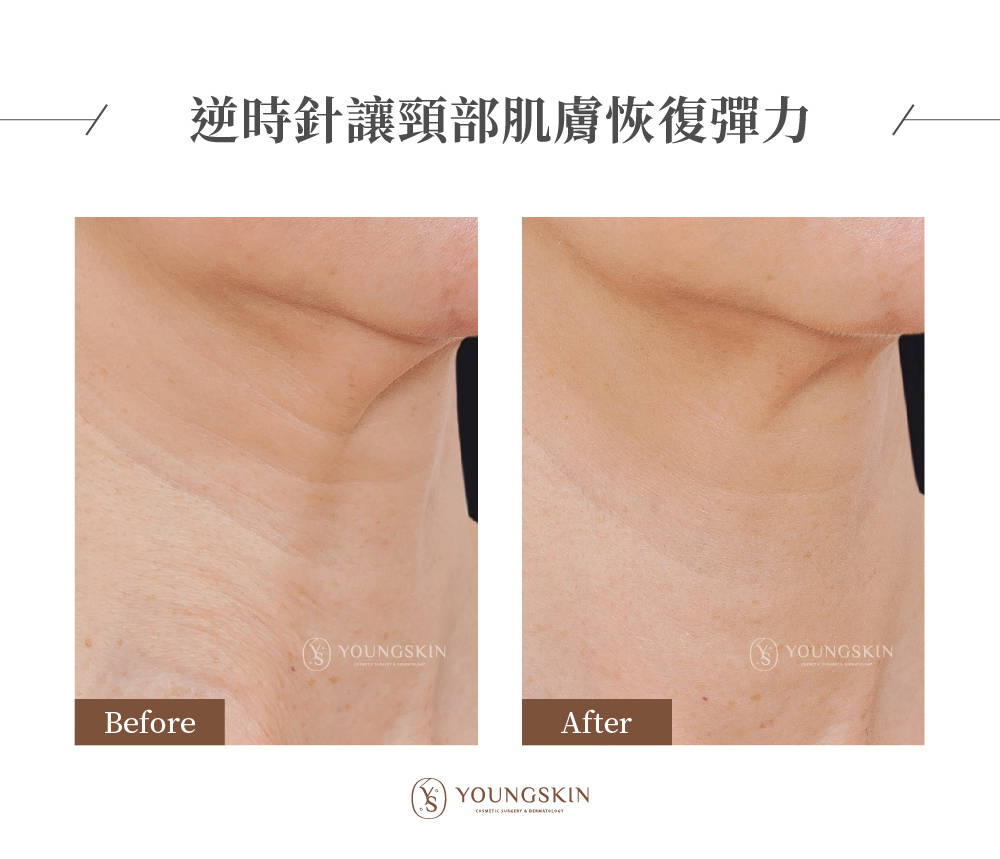 芯漾案例透過Profhilo逆時針結合醫師注射手法，改善後頸部肌膚緊緻度、平滑度與光澤感都有明顯提升，彈潤感也更出來了，整體線條更顯年輕。