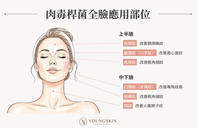 肉毒桿菌可以打哪裡？